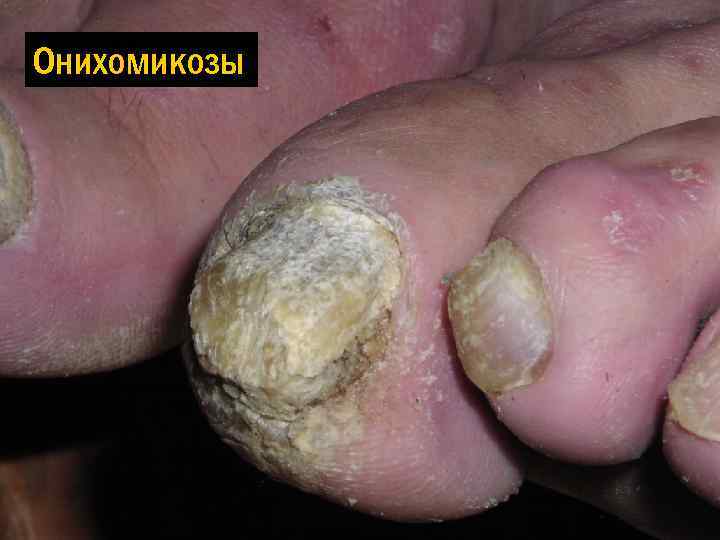 Онихомикозы 