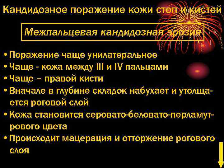 Кандидозное поражение кожи стоп и кистей Межпальцевая кандидозная эрозия • Поражение чаще унилатеральное •