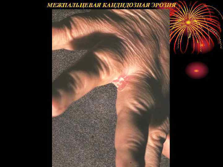 МЕЖПАЛЬЦЕВАЯ КАНДИДОЗНАЯ ЭРОЗИЯ 