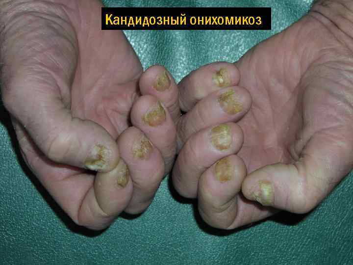 Кандидозный онихомикоз 