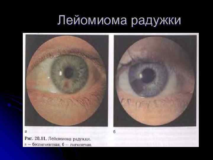 Лейомиома радужки 