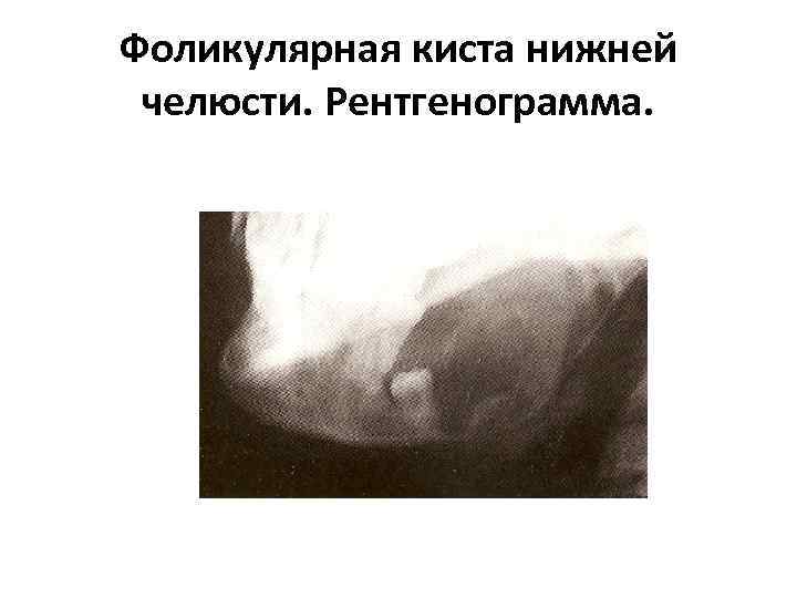 Фоликулярная киста нижней челюсти. Рентгенограмма. 