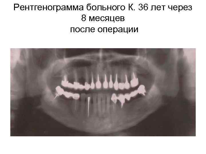 Рентгенограмма больного К. 36 лет через 8 месяцев после операции 