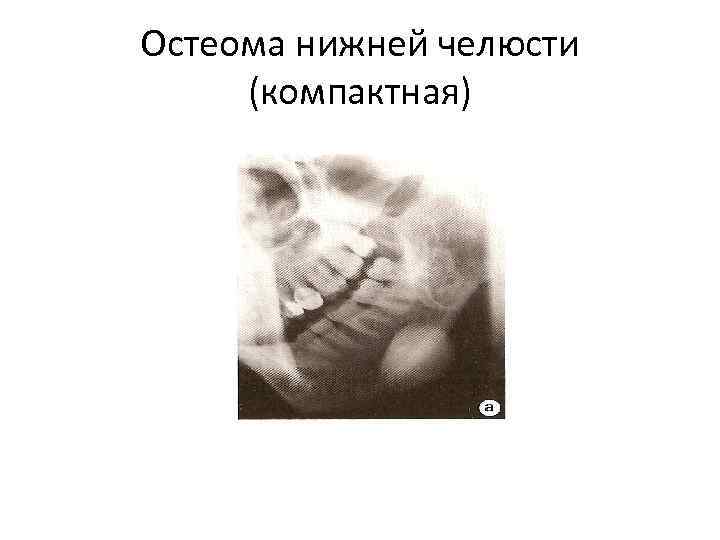 Остеома нижней челюсти (компактная) 
