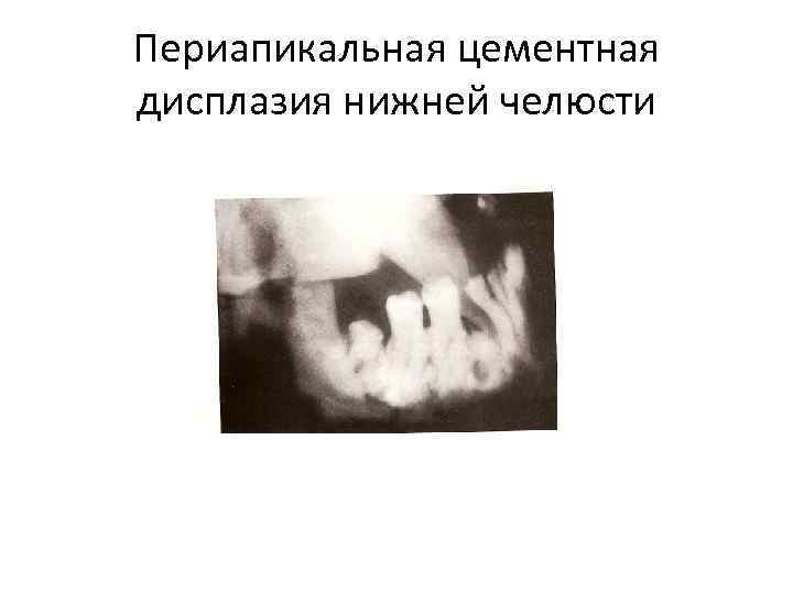 Периапикальная цементная дисплазия нижней челюсти 