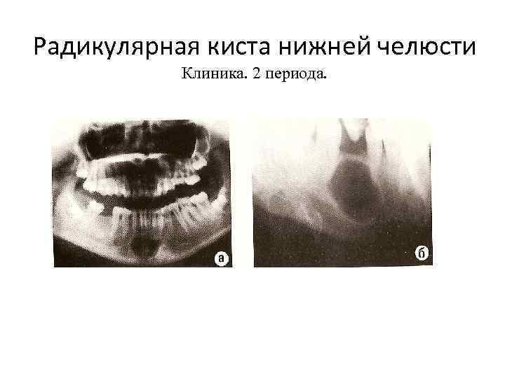 Радикулярная киста нижней челюсти Клиника. 2 периода. 