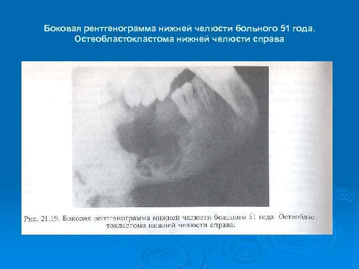 Боковая рентгенограмма нижней челюсти больного 51 года. Остеобластокластома нижней челюсти справа 