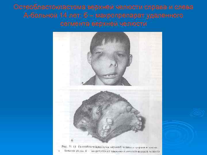 Остеобластокластома верхней челюсти справа и слева А-больной 14 лет; б – макропрепарат удаленного сегмента