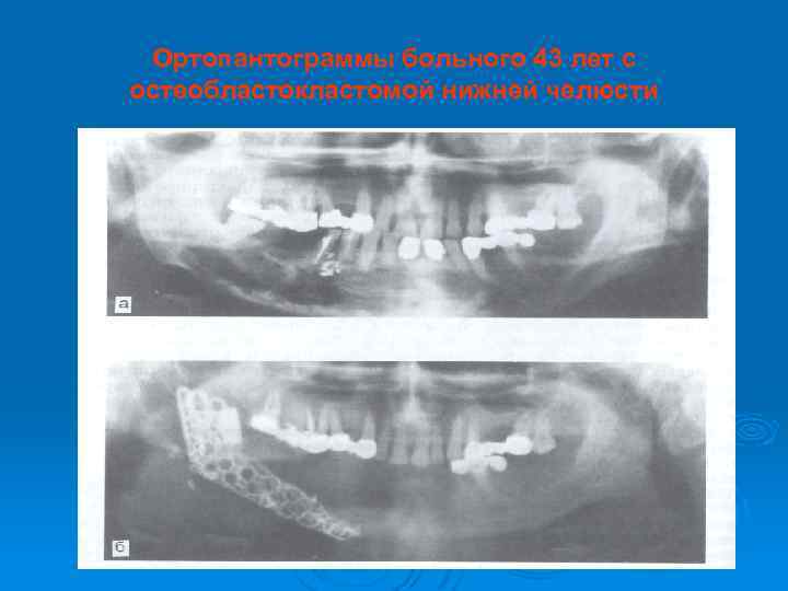 Ортопантограммы больного 43 лет с остеобластокластомой нижней челюсти 