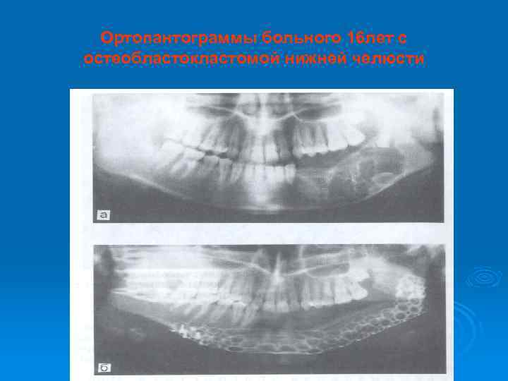 Ортопантограммы больного 16 лет с остеобластокластомой нижней челюсти 