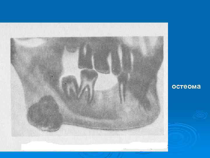 Остеобластокластома челюсти фото