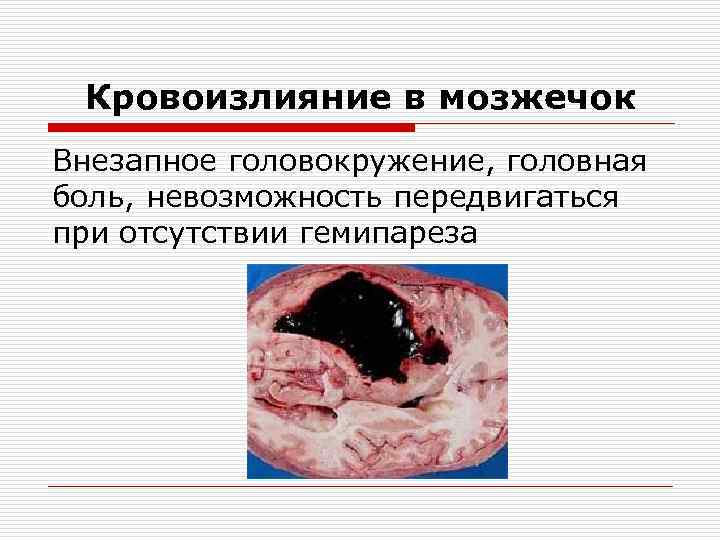 Кровоизлияние в мозжечок Внезапное головокружение, головная боль, невозможность передвигаться при отсутствии гемипареза 