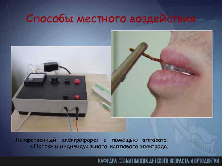 Способы местного воздействия Лекарственный электрофорез с помощью аппарата «Поток» и индивидуального каппового электрода. 