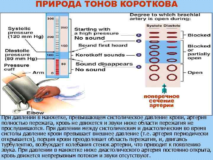 ПРИРОДА ТОНОВ КОРОТКОВА поперечное сечение артерии При давлении в манжетке, превышающем систолическое давление крови,