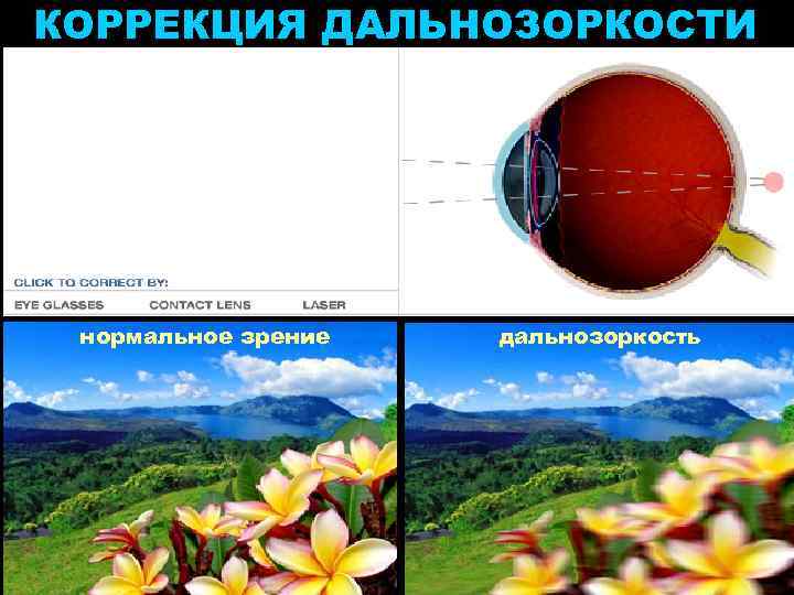 КОРРЕКЦИЯ ДАЛЬНОЗОРКОСТИ нормальное зрение дальнозоркость 
