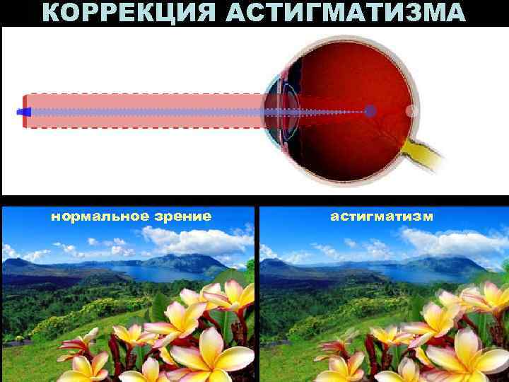 КОРРЕКЦИЯ АСТИГМАТИЗМА нормальное зрение астигматизм 