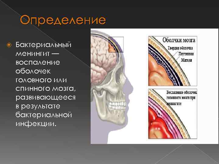 Определение Бактериальный менингит — воспаление оболочек головного или спинного мозга, развивающееся в результате бактериальной
