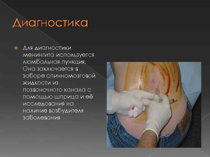 Диагностика Для диагностики менингита используется люмбальная пункция. Она заключается в заборе спинномозговой жидкости из