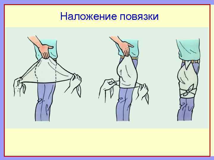 Наложение повязки 