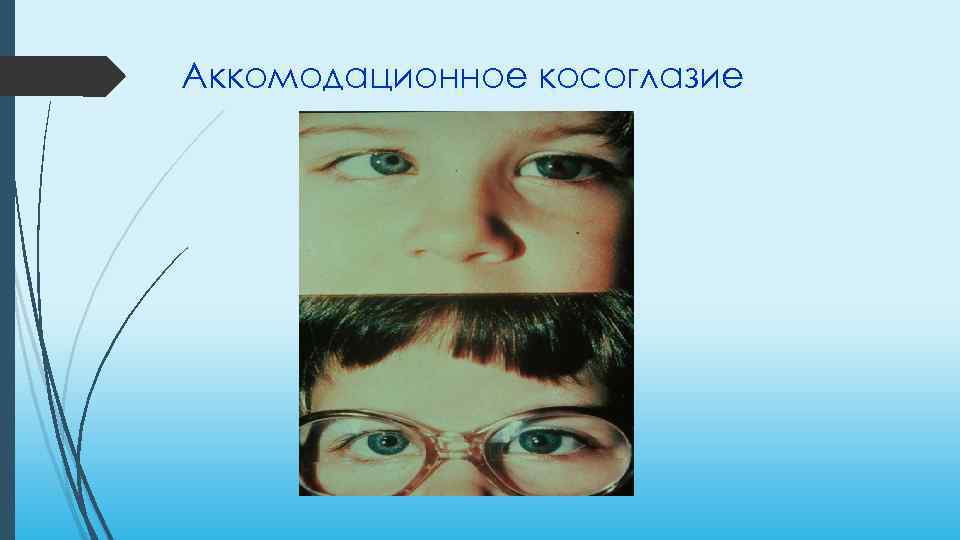 Аккомодационное косоглазие 