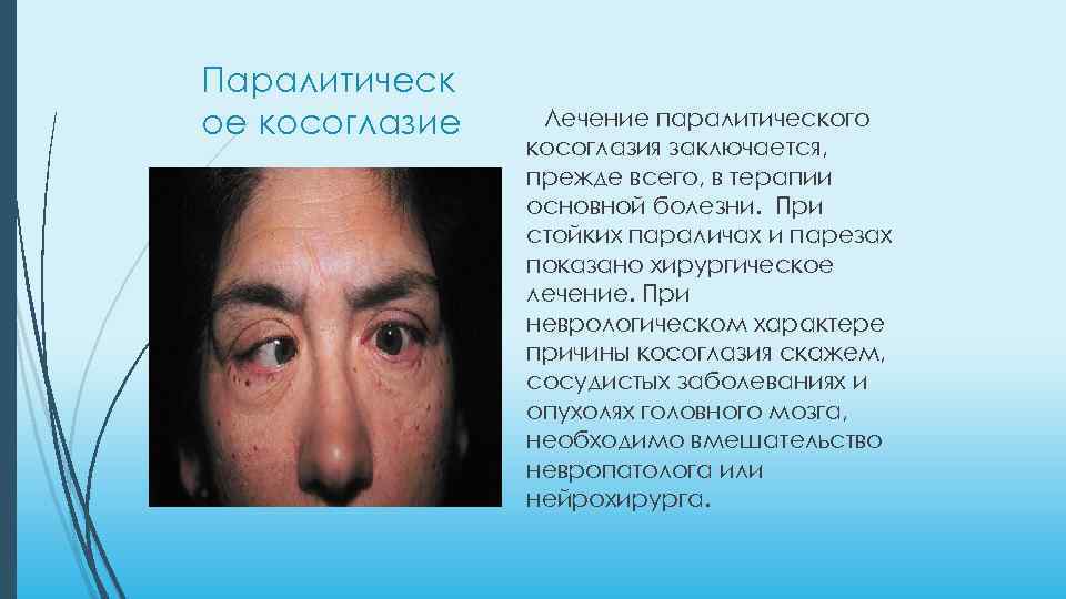 Паралитическ ое косоглазие Лечение паралитического косоглазия заключается, прежде всего, в терапии основной болезни. При