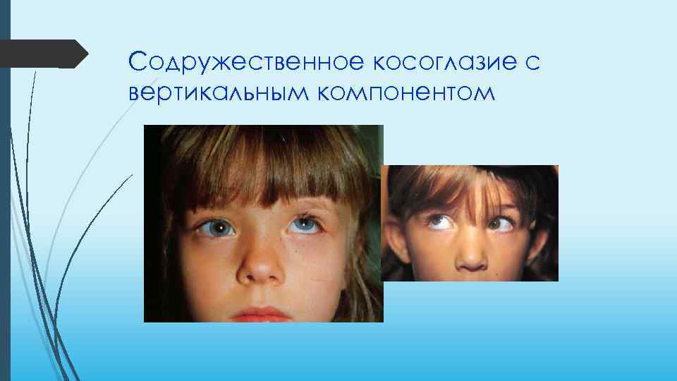 Содружественное косоглазие с вертикальным компонентом 