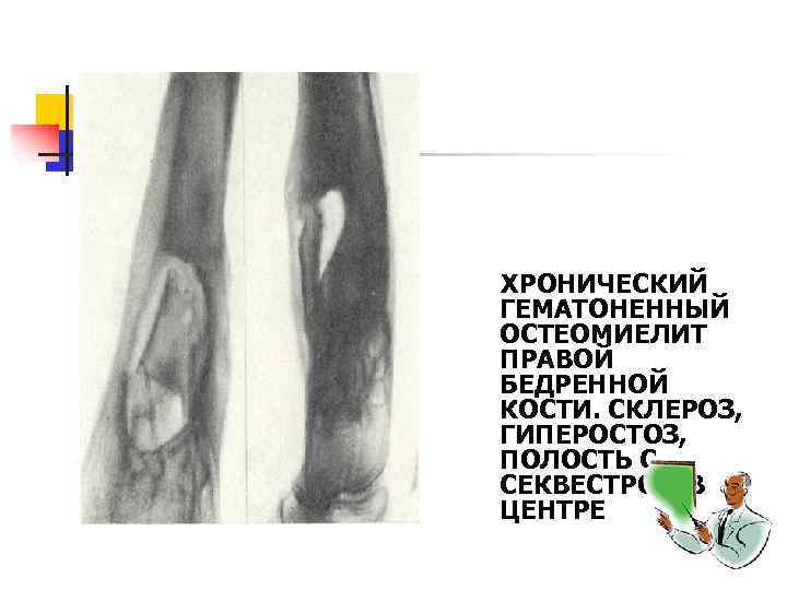 ХРОНИЧЕСКИЙ ГЕМАТОНЕННЫЙ ОСТЕОМИЕЛИТ ПРАВОЙ БЕДРЕННОЙ КОСТИ. СКЛЕРОЗ, ГИПЕРОСТОЗ, ПОЛОСТЬ С СЕКВЕСТРОМ В ЦЕНТРЕ 
