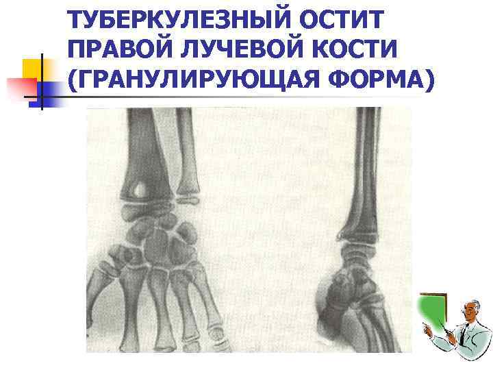 ТУБЕРКУЛЕЗНЫЙ ОСТИТ ПРАВОЙ ЛУЧЕВОЙ КОСТИ (ГРАНУЛИРУЮЩАЯ ФОРМА) 