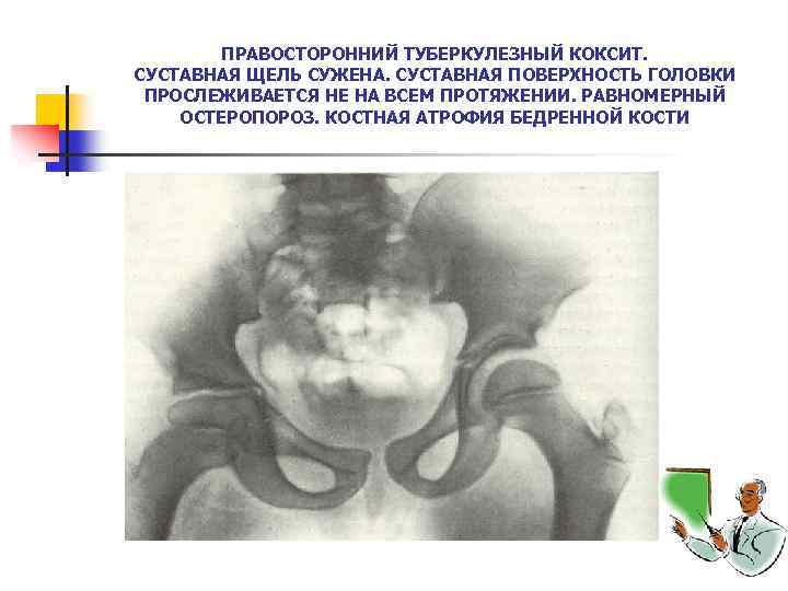 ПРАВОСТОРОННИЙ ТУБЕРКУЛЕЗНЫЙ КОКСИТ. СУСТАВНАЯ ЩЕЛЬ СУЖЕНА. СУСТАВНАЯ ПОВЕРХНОСТЬ ГОЛОВКИ ПРОСЛЕЖИВАЕТСЯ НЕ НА ВСЕМ ПРОТЯЖЕНИИ.