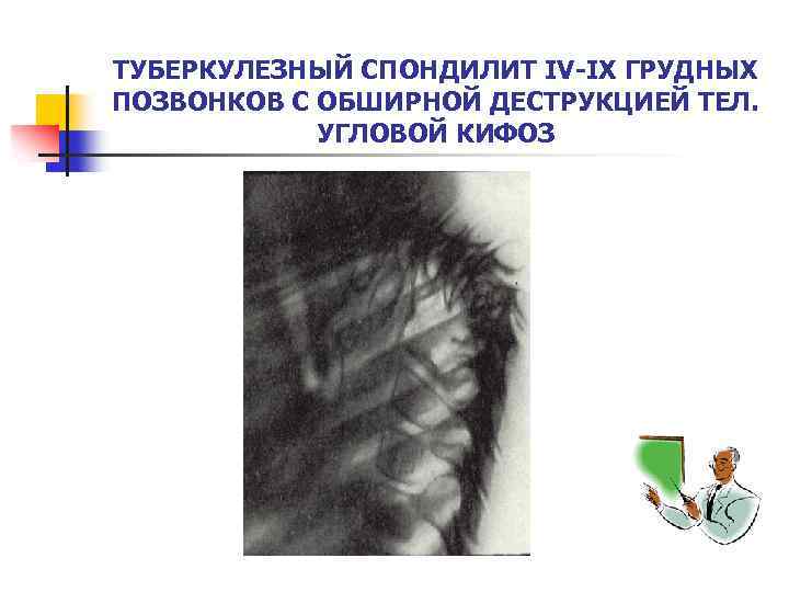 ТУБЕРКУЛЕЗНЫЙ СПОНДИЛИТ IV-IX ГРУДНЫХ ПОЗВОНКОВ С ОБШИРНОЙ ДЕСТРУКЦИЕЙ ТЕЛ. УГЛОВОЙ КИФОЗ 