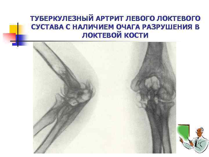 ТУБЕРКУЛЕЗНЫЙ АРТРИТ ЛЕВОГО ЛОКТЕВОГО СУСТАВА С НАЛИЧИЕМ ОЧАГА РАЗРУШЕНИЯ В ЛОКТЕВОЙ КОСТИ 