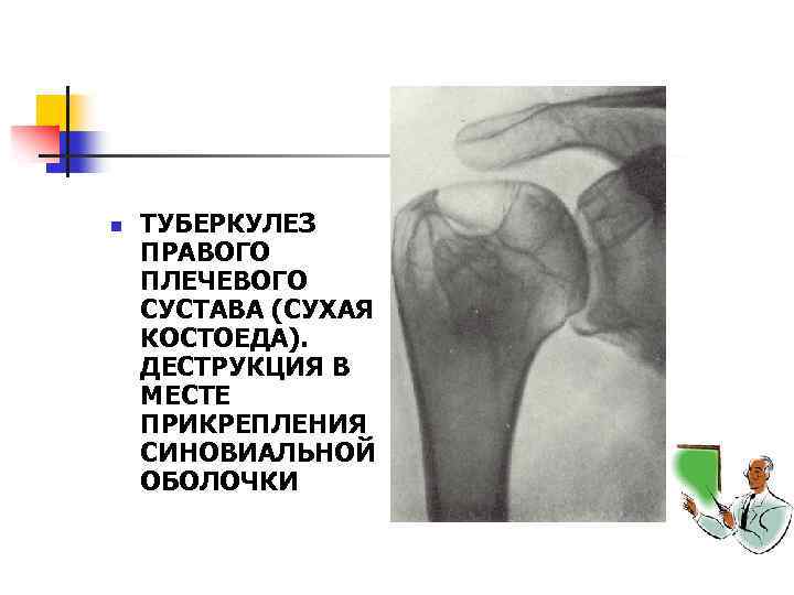 n ТУБЕРКУЛЕЗ ПРАВОГО ПЛЕЧЕВОГО СУСТАВА (СУХАЯ КОСТОЕДА). ДЕСТРУКЦИЯ В МЕСТЕ ПРИКРЕПЛЕНИЯ СИНОВИАЛЬНОЙ ОБОЛОЧКИ 