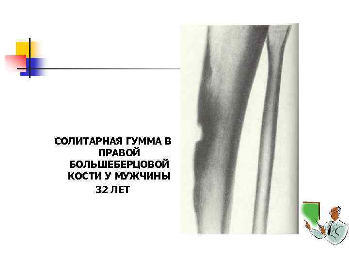 СОЛИТАРНАЯ ГУММА В ПРАВОЙ БОЛЬШЕБЕРЦОВОЙ КОСТИ У МУЖЧИНЫ 32 ЛЕТ 