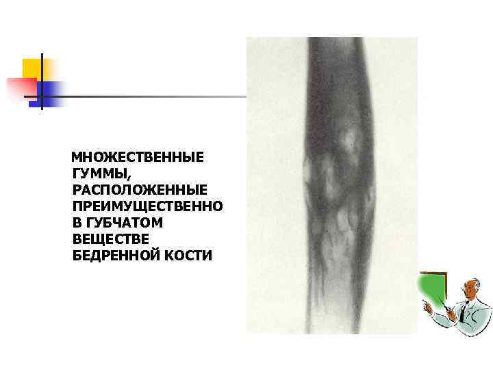 МНОЖЕСТВЕННЫЕ ГУММЫ, РАСПОЛОЖЕННЫЕ ПРЕИМУЩЕСТВЕННО В ГУБЧАТОМ ВЕЩЕСТВЕ БЕДРЕННОЙ КОСТИ 