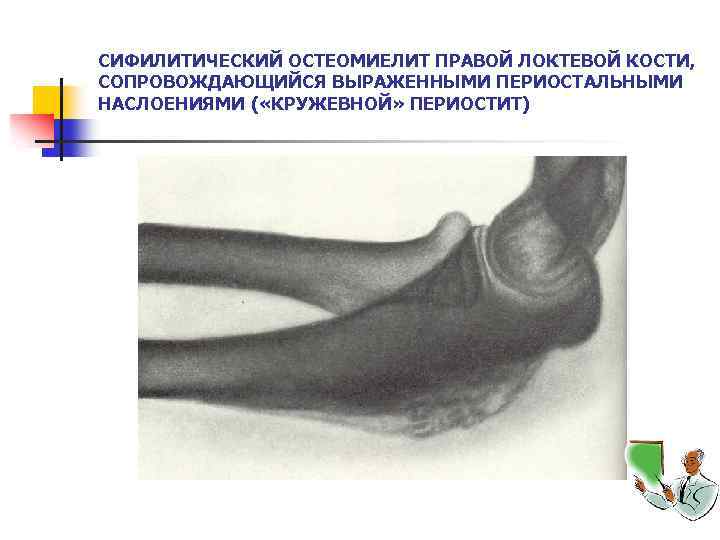 СИФИЛИТИЧЕСКИЙ ОСТЕОМИЕЛИТ ПРАВОЙ ЛОКТЕВОЙ КОСТИ, СОПРОВОЖДАЮЩИЙСЯ ВЫРАЖЕННЫМИ ПЕРИОСТАЛЬНЫМИ НАСЛОЕНИЯМИ ( «КРУЖЕВНОЙ» ПЕРИОСТИТ) 