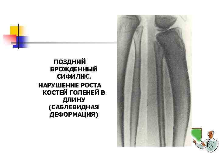 ПОЗДНИЙ ВРОЖДЕННЫЙ СИФИЛИС. НАРУШЕНИЕ РОСТА КОСТЕЙ ГОЛЕНЕЙ В ДЛИНУ (САБЛЕВИДНАЯ ДЕФОРМАЦИЯ) 