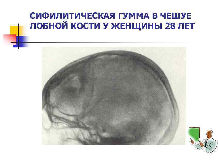 СИФИЛИТИЧЕСКАЯ ГУММА В ЧЕШУЕ ЛОБНОЙ КОСТИ У ЖЕНЩИНЫ 28 ЛЕТ 