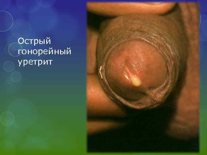Острый гонорейный уретрит 