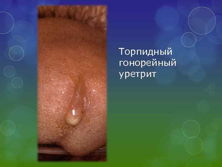 Торпидный гонорейный уретрит 