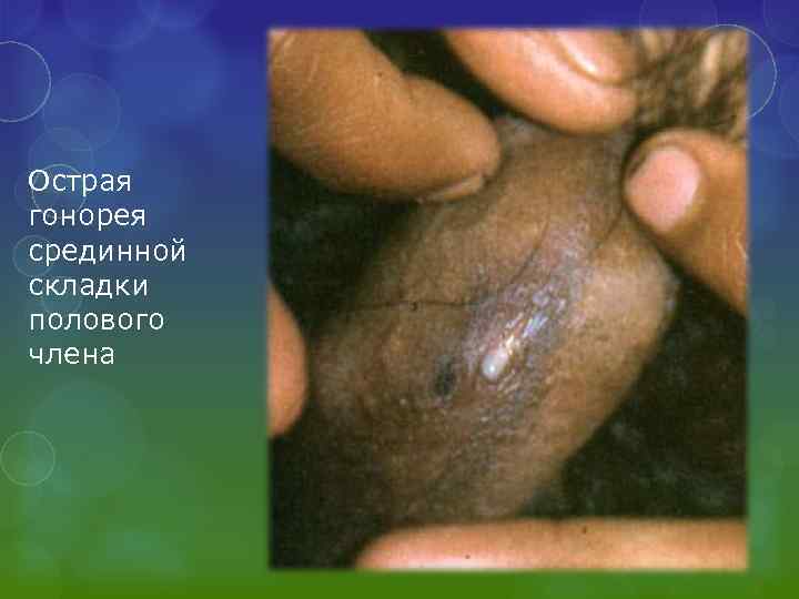 Острая гонорея срединной складки полового члена 