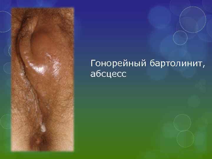 Гонорейный бартолинит, абсцесс 