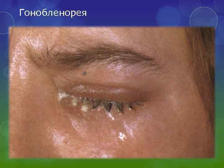 Гонобленорея 