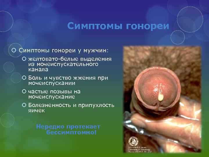 Симптомы гонореи у мужчин: желтовато-белые выделения из мочеиспускательного канала Боль и чувство жжения при