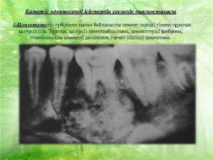 Қатерсіз одонтогенді ісіктердің сәулелік диагностикасы 3 -Цементома-тіс түбірімен тығыз байланысты цемент тәрізді тіннен тұратын