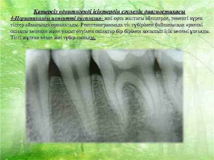 Қатерсіз одонтогенді ісіктердің сәулелік диагностикасы 4 -Периапикалды цементті дисплазия- жиі орта жастағы әйелдерде, төменгі