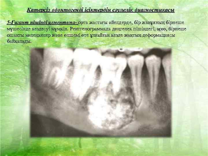 Қатерсіз одонтогенді ісіктердің сәулелік диагностикасы 5 -Гигант пішінді цементома- орта жастағы әйелдерде, бір жанұяның