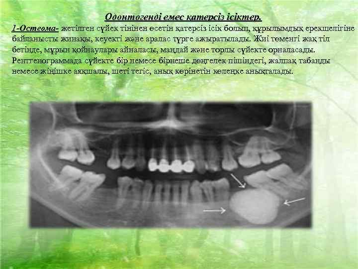 Одонтогенді емес қатерсіз ісіктер. 1 -Остеома- жетілген сүйек тінінен өсетін қатерсіз ісік болып, құрылымдық