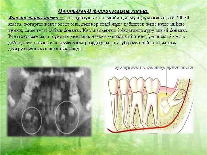  Одонтогенді фолликулярлы киста. Фолликулярлы киста – тісті құраушы эпителийдің даму ақауы болып, жиі