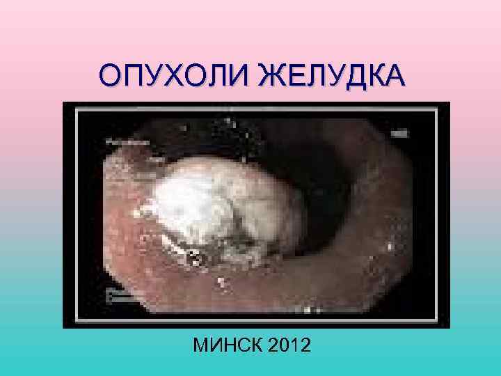 ОПУХОЛИ ЖЕЛУДКА МИНСК 2012 