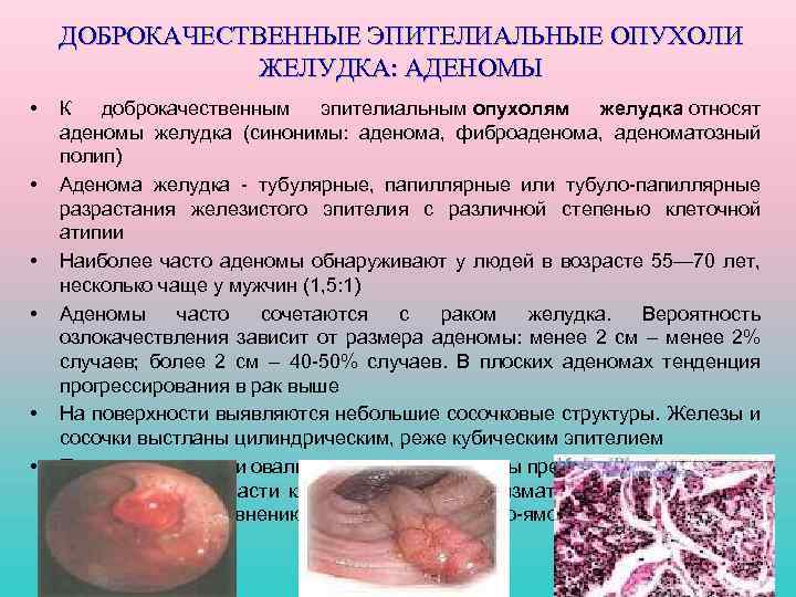 ДОБРОКАЧЕСТВЕННЫЕ ЭПИТЕЛИАЛЬНЫЕ ОПУХОЛИ ЖЕЛУДКА: АДЕНОМЫ • • • К доброкачественным эпителиальным опухолям желудка относят